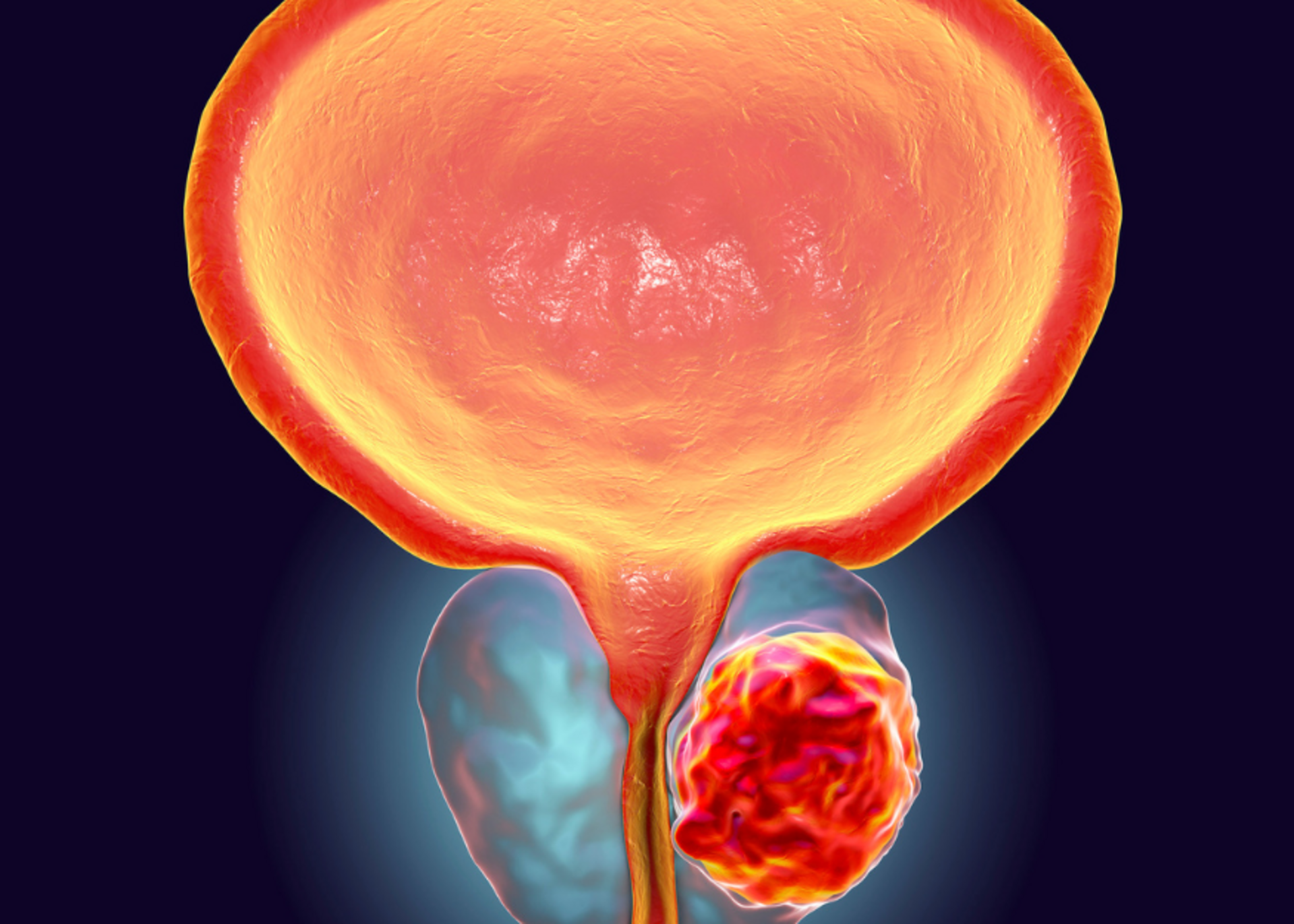 Bladder Cancer Management
